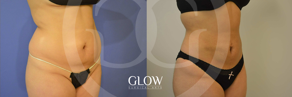 Liposuction from Glow Surgical Arts