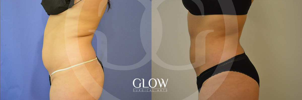 Liposuction from Glow Surgical Arts