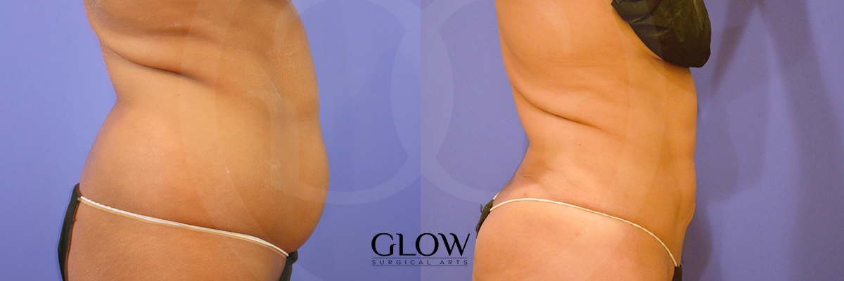 Liposuction from Glow Surgical Arts