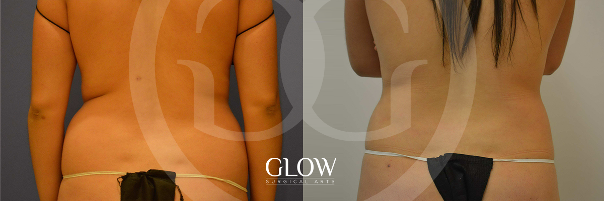 Liposuction from Glow Surgical Arts
