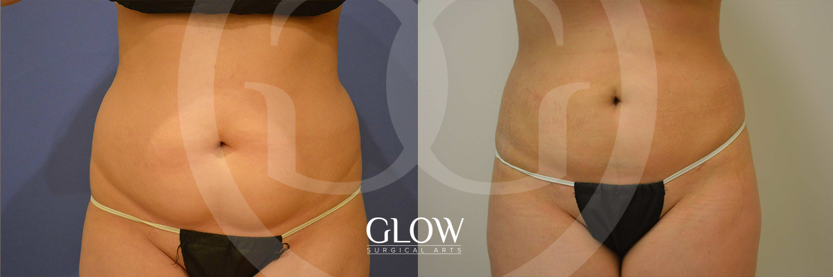 Liposuction from Glow Surgical Arts