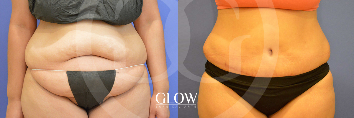 Tummy Tuck before & after bay area