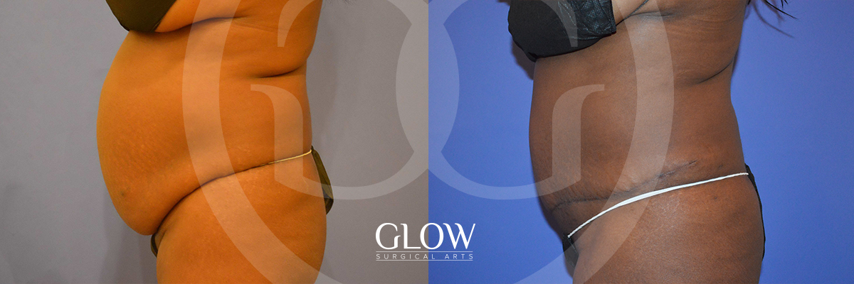 Tummy Tuck before & after Glow Surgical Arts
