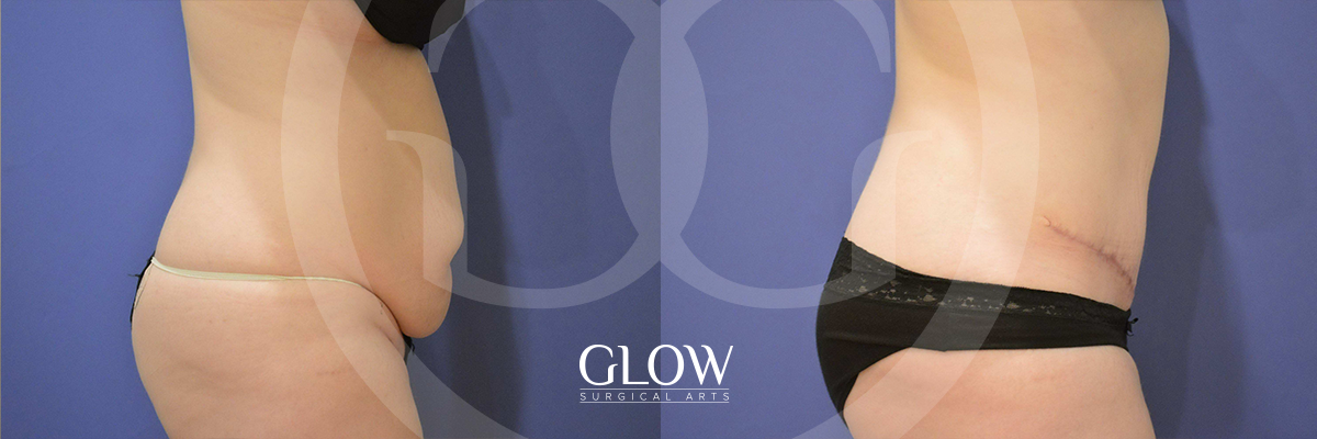 Tummy Tuck before & after San Francisco