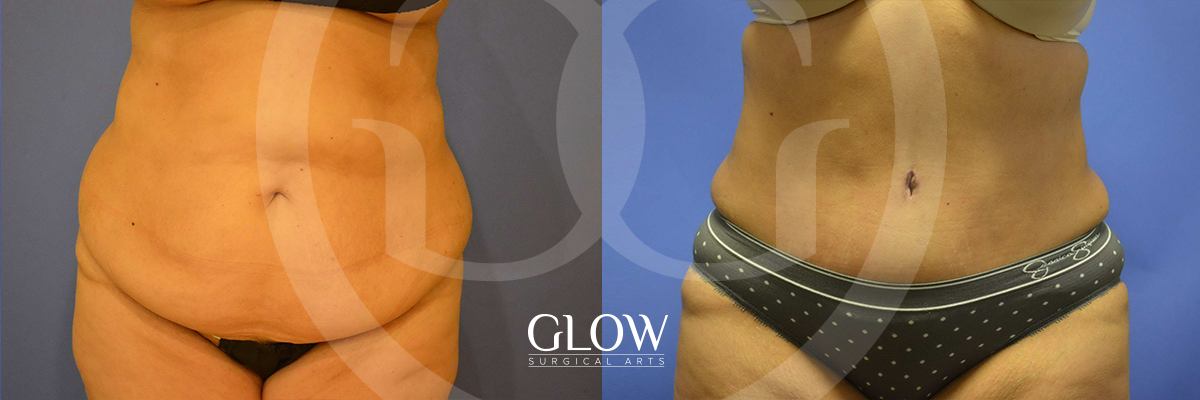 Tummy Tuck before & after San Francisco