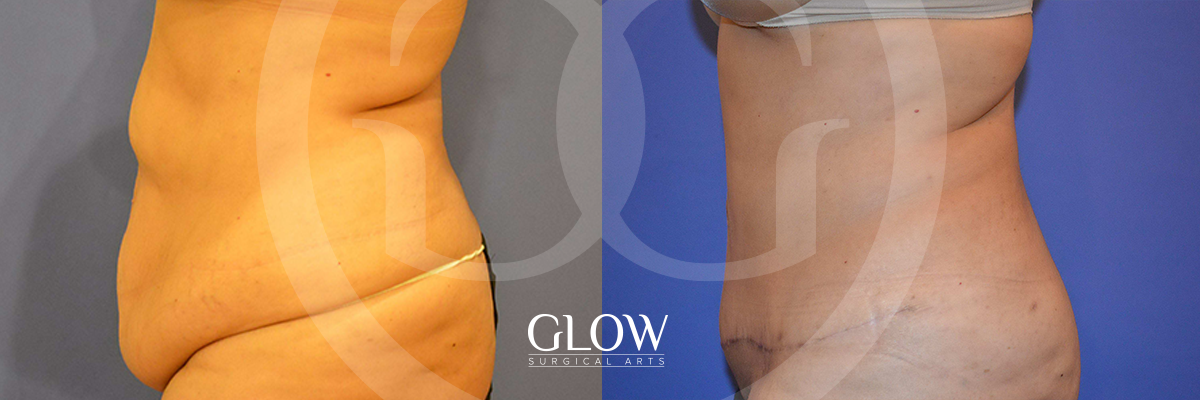 CE-left-tummy-tuck-slide.png