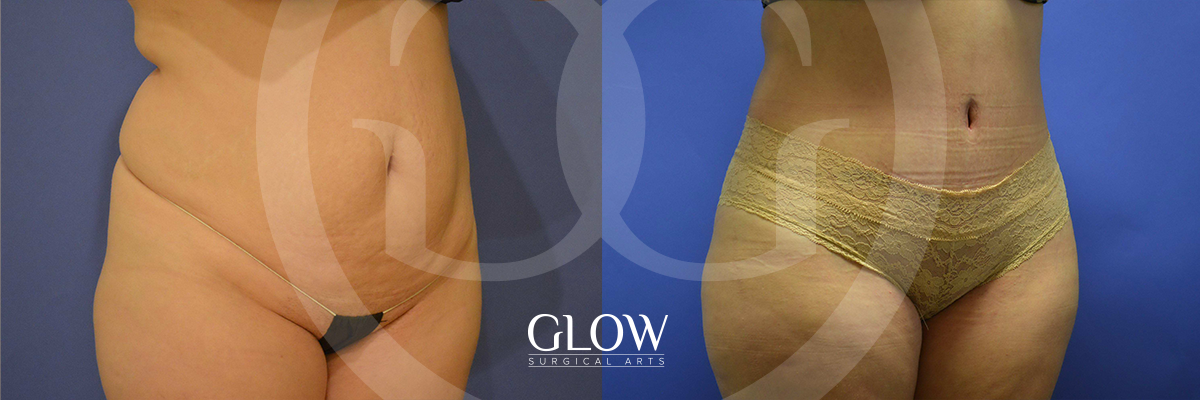 Tummy Tuck before & after San Francisco