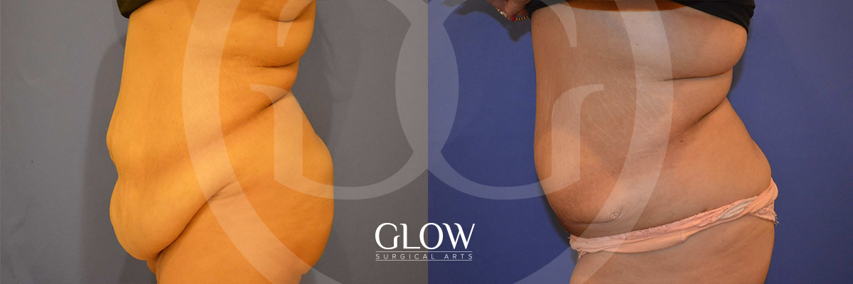 DL-side-tummy-tuck-slide.png