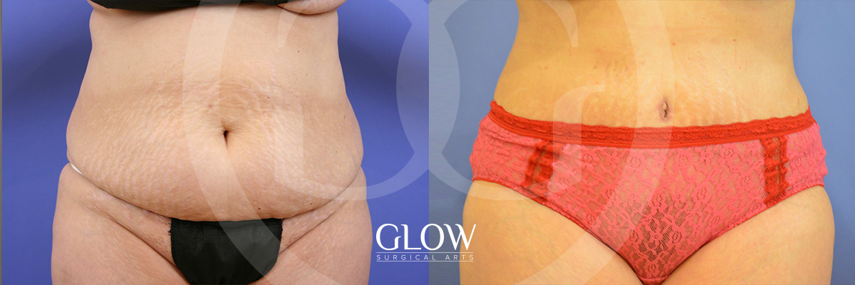Tummy Tuck before & after San Francisco