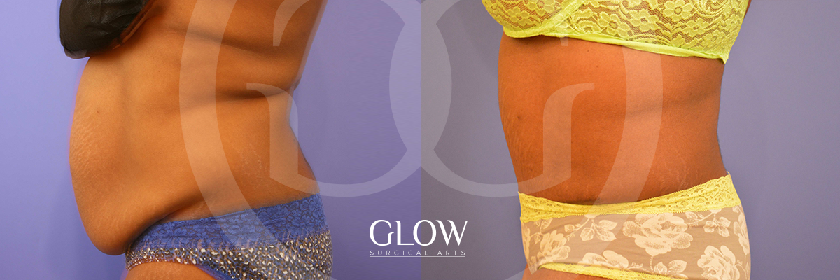 Tummy Tuck before & after Glow Surgical Arts