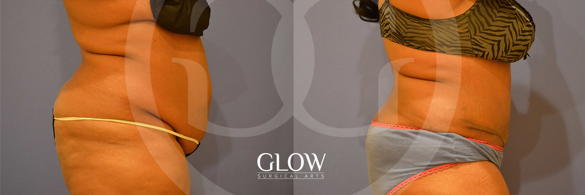 Tummy Tuck before & after San Francisco