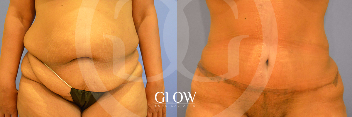 Tummy Tuck before & after San Francisco
