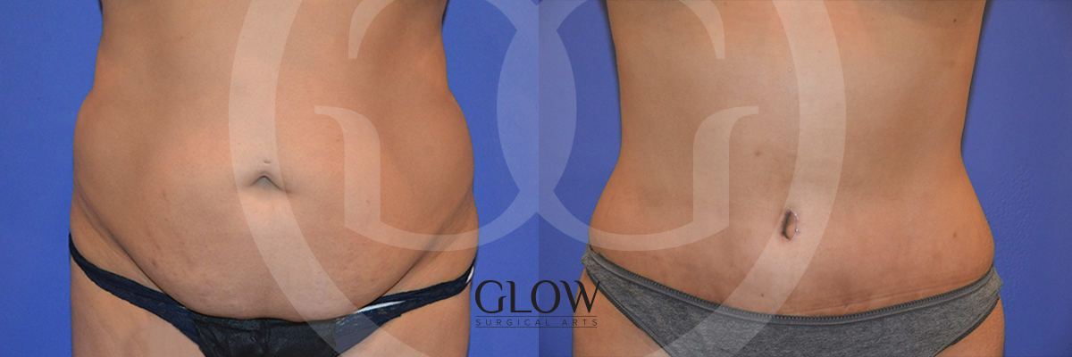 GLO-Tummy-Tuck-Case-10.png