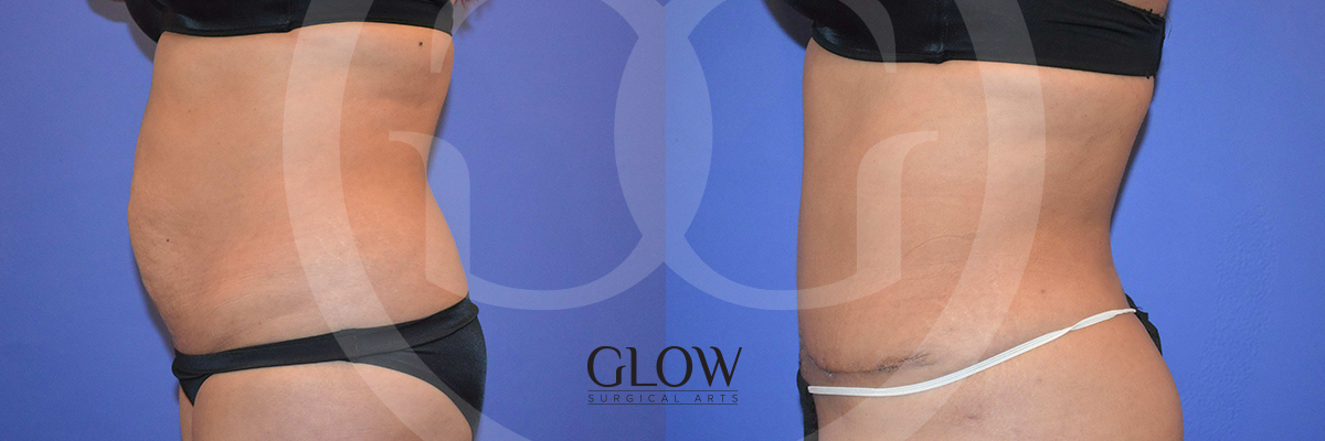 GLO-Tummy-Tuck-Case-11.png