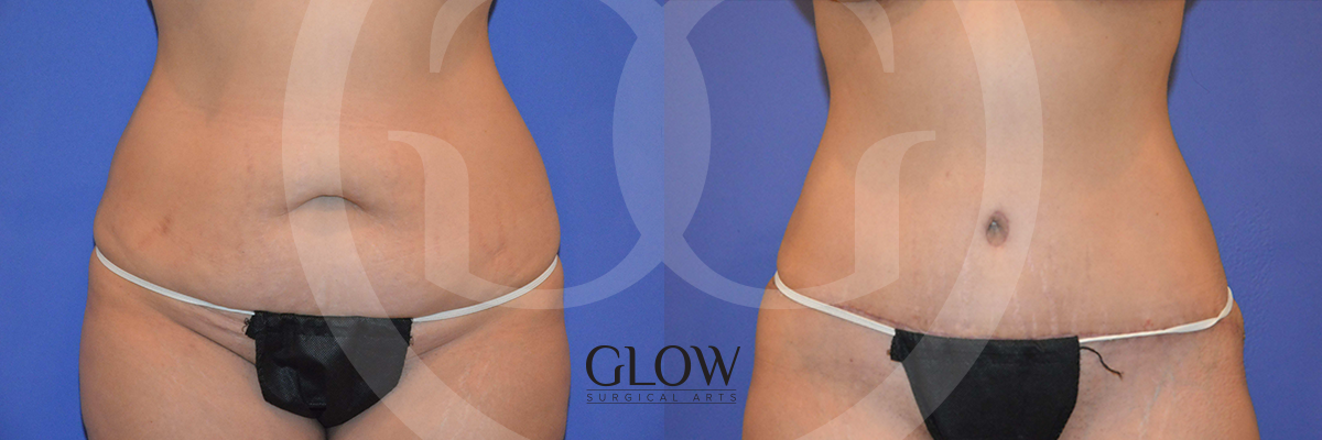 GLO-Tummy-Tuck-Case-6.png