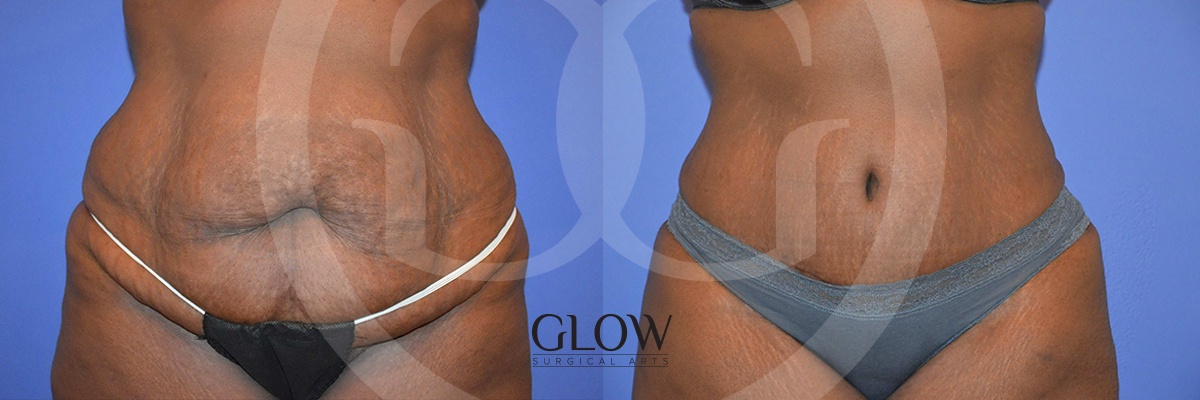 GLO-Tummy-Tuck-Case-7.png