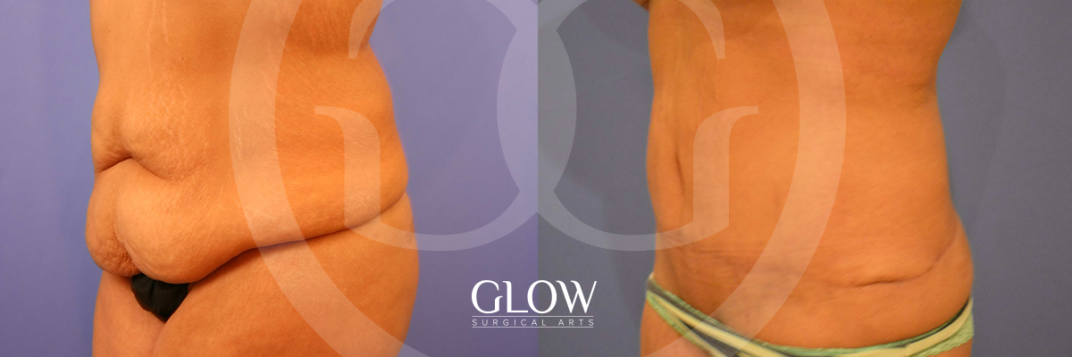 Tummy Tuck before & after San Francisco
