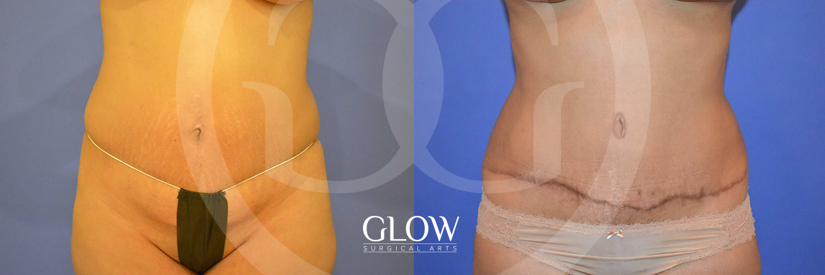 Tummy Tuck before & after San Francisco