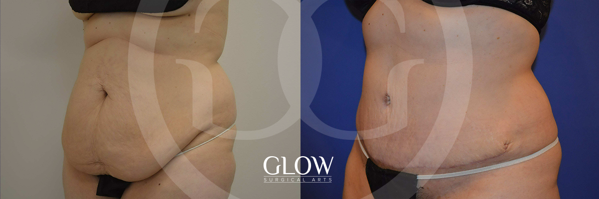 Tummy Tuck before & after San Francisco