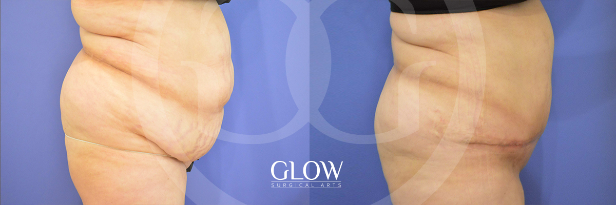Tummy Tuck before & after San Francisco