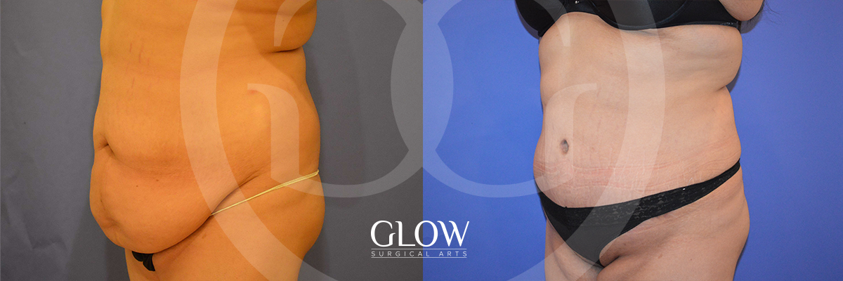 Tummy Tuck before & after San Francisco
