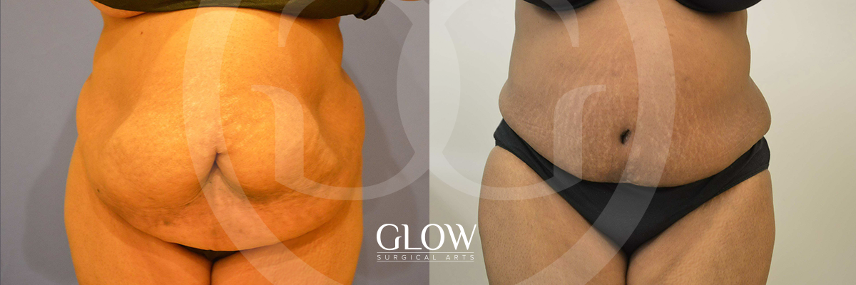 Tummy Tuck before & after San Francisco