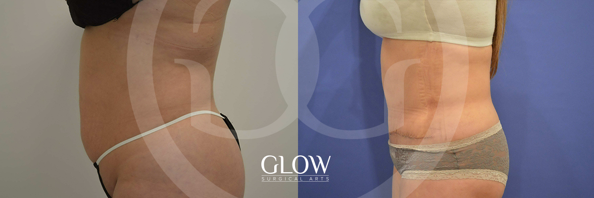 Tummy Tuck before & after San Francisco