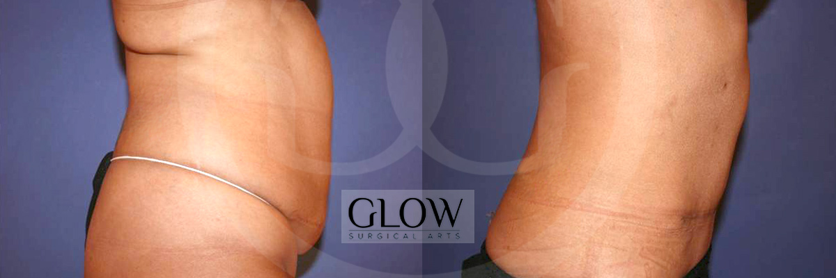 Tummy Tuck before & after San Francisco