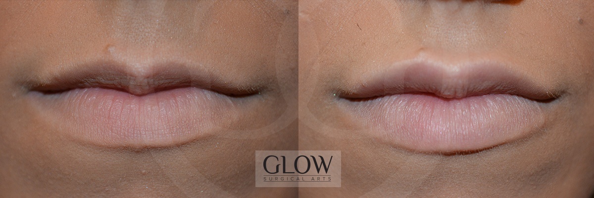 GLO-Injectables--Fillers-Case-10.jpg