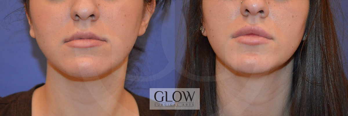 GLO-Injectables--Fillers-Case-11.jpg
