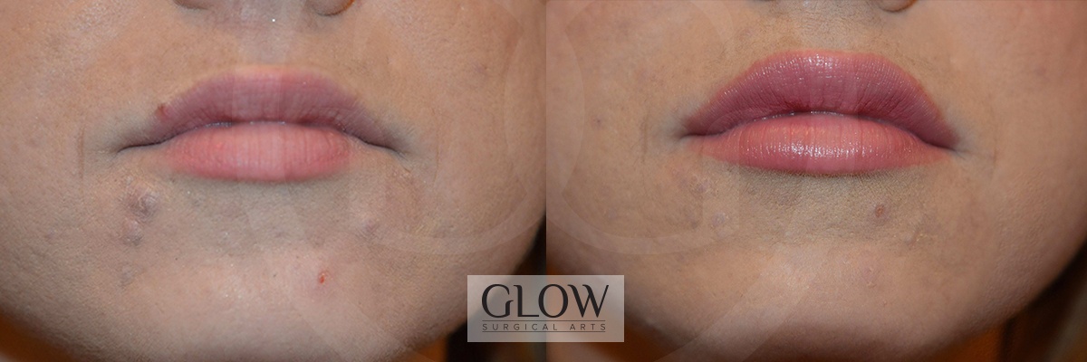 GLO-Injectables--Fillers-Case-12a.jpg