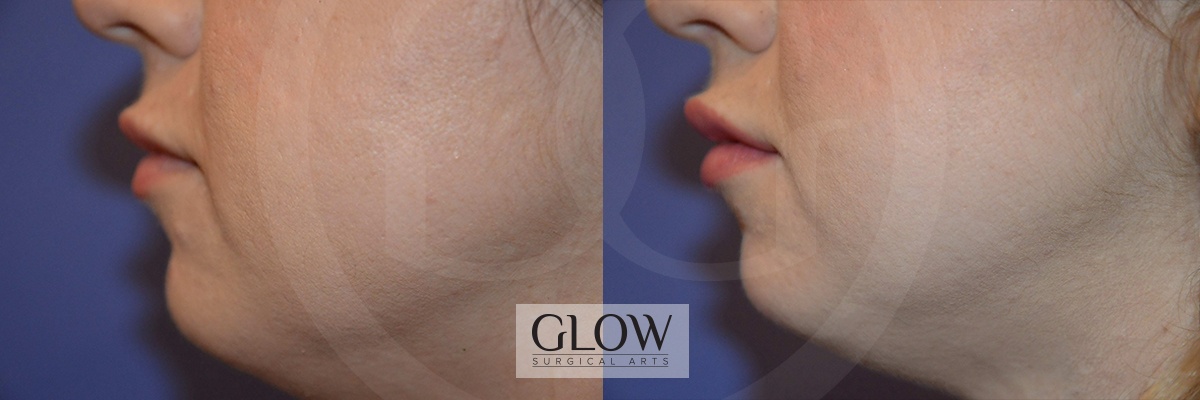 GLO-Injectables--Fillers-Case-12b.jpg