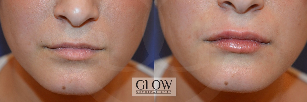 GLO-Injectables--Fillers-Case-13.jpg