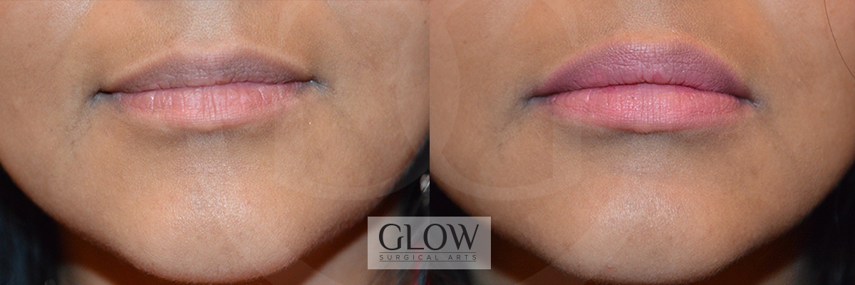 GLO-Injectables--Fillers-Case-14.jpg
