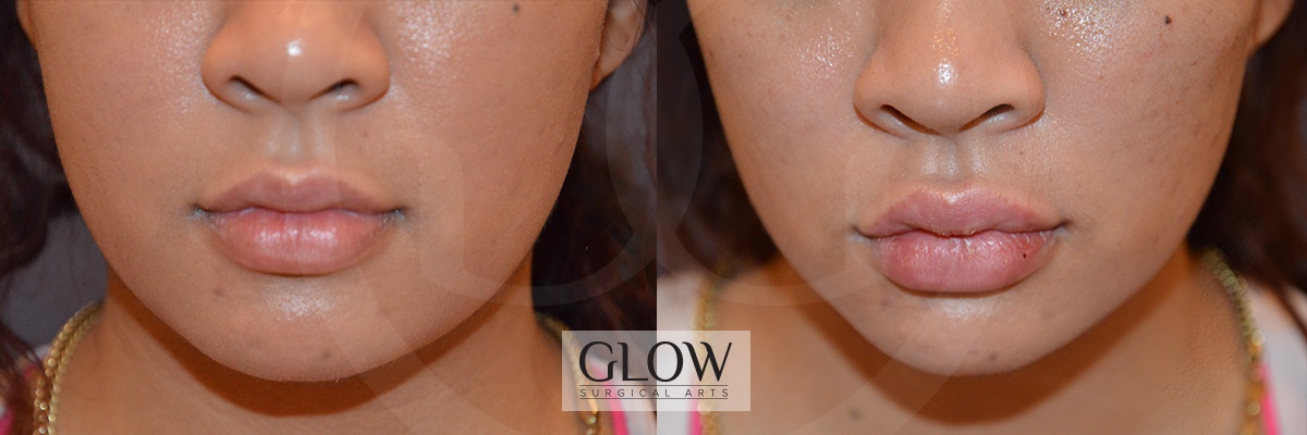 GLO-Injectables--Fillers-Case-15-1.jpg