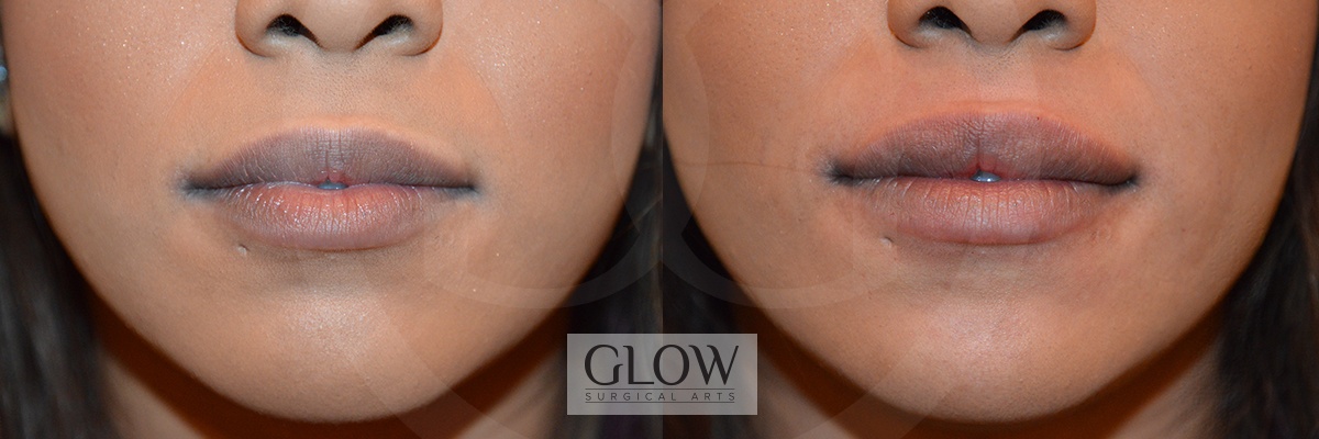 GLO-Injectables--Fillers-Case-16.jpg