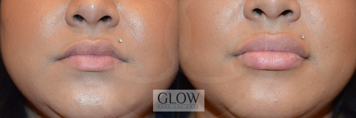 GLO-Injectables--Fillers-Case-17.jpg