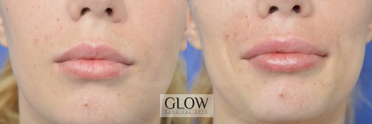 GLO-Injectables--Fillers-Case-18.jpg
