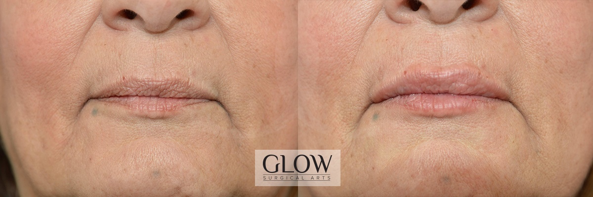 GLO-Injectables--Fillers-Case-19.jpg
