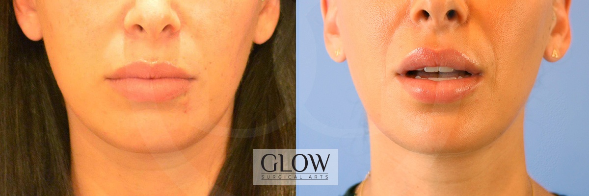 GLO-Injectables--Fillers-Case-20a.jpg