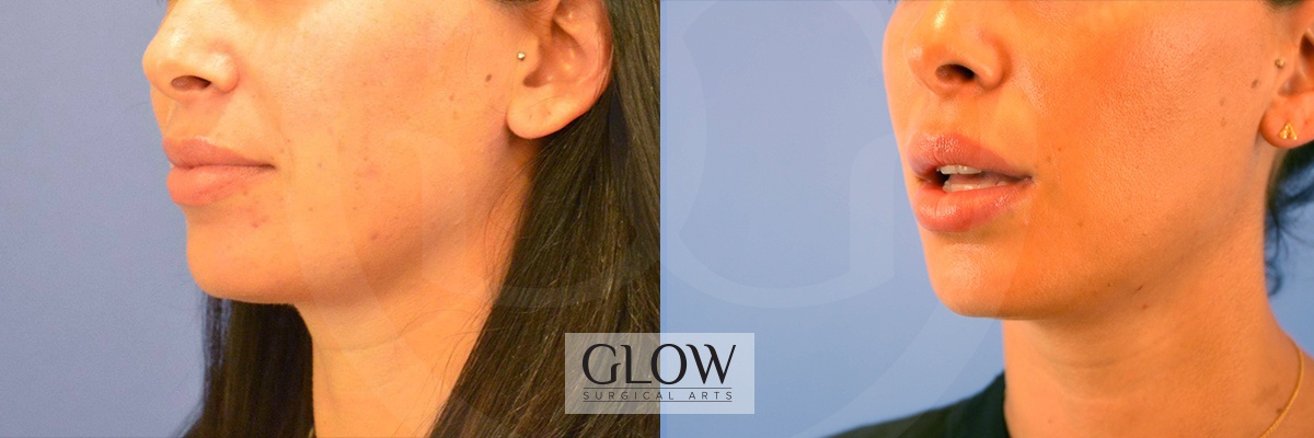 GLO-Injectables--Fillers-Case-20b.jpg