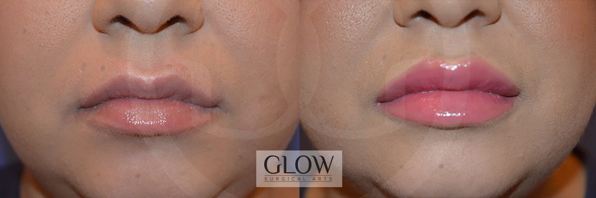 GLO-Injectables--Fillers-Case-21.jpg