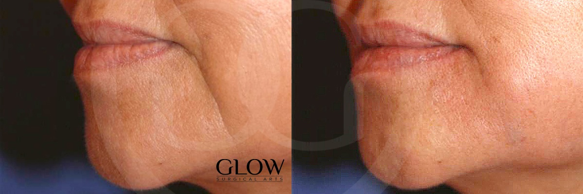 GLO-Injectables--Fillers-Case-22.jpg